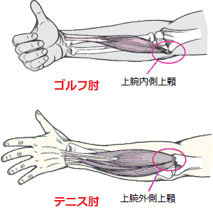 テニス肘・ゴルフ肘.jpg